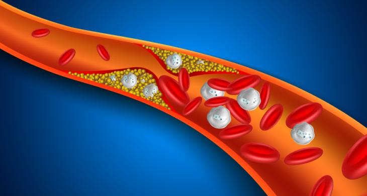 nanoparticles reduce plaques
