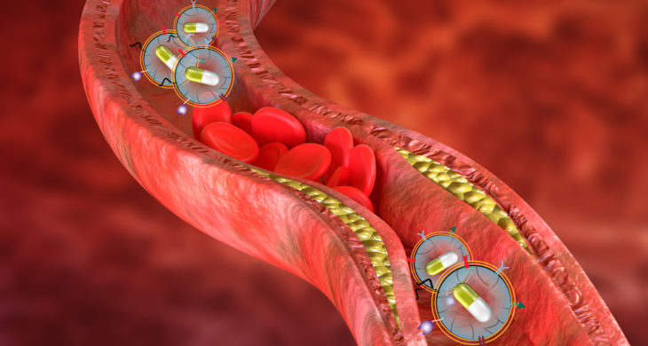 treating atherosclerosis with macrophage membrane coated nanoparticles