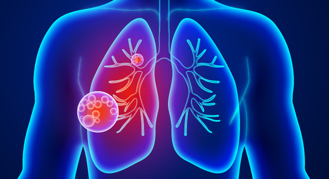 nanosensors detect lung disease
