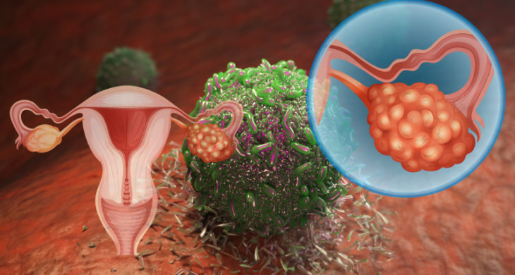 new approach for ovarian immunotherapy resistant cancer